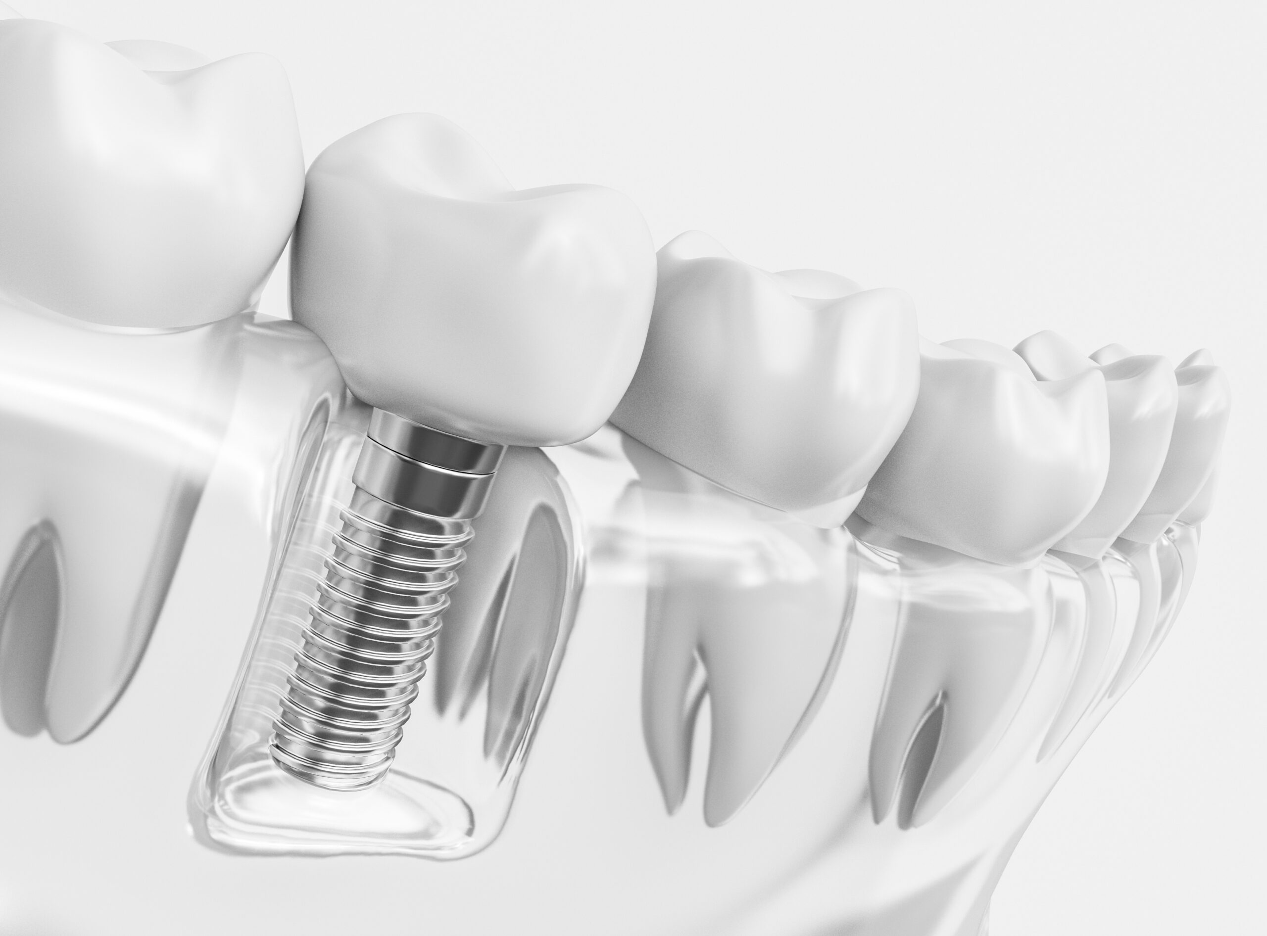 dental implants Clinton